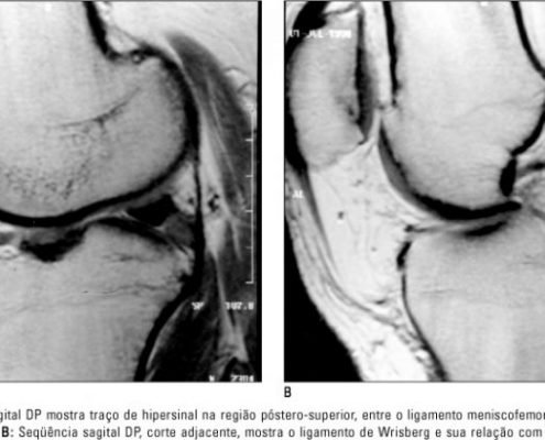 lesao-meniscal (3)