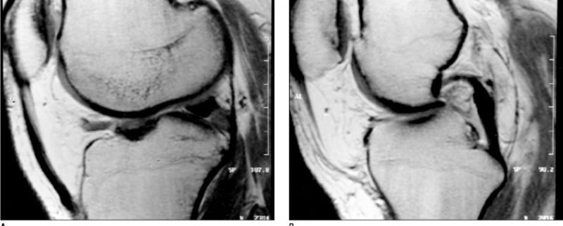 lesao-meniscal (3)