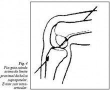 fio-guia saindo acima do limite (fig 04)