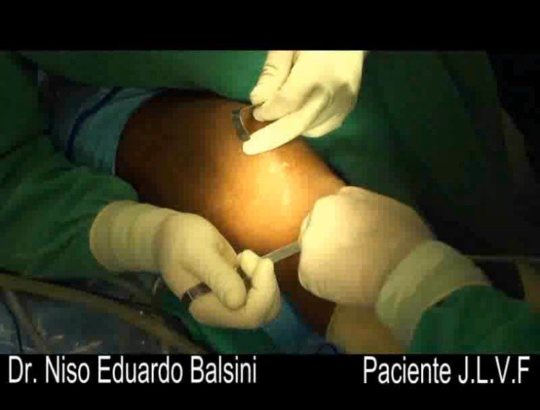 Ligamento patelo femoral