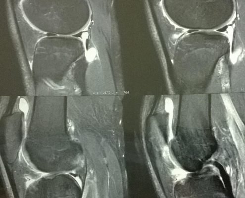 Figura 1 - Imagem de ressonancia mostrando uma lesao do ligamento cruzado anterior e uma lesao em alca de balde do menisco lateral