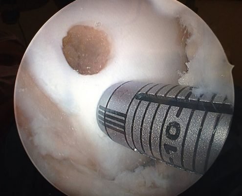 Figura 7 - Enxerto de cartilagem sendo retirado de uma area que nao tem carga para ser implantado na regiao de carga do joelho