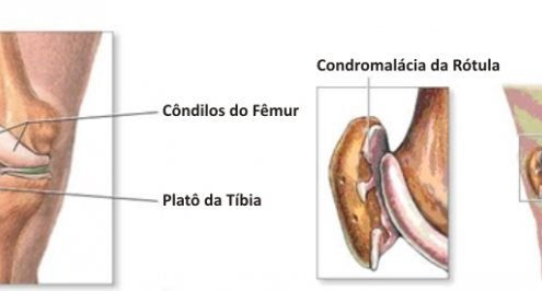 dor-femuro-patelar (6)