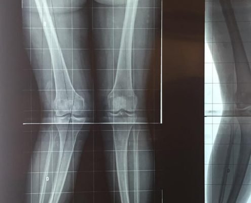 o que resulta do aumento no angulo entre o femur e tibia